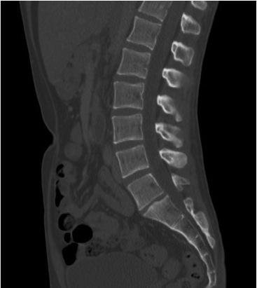 CT of a Normal Lumbar Spine