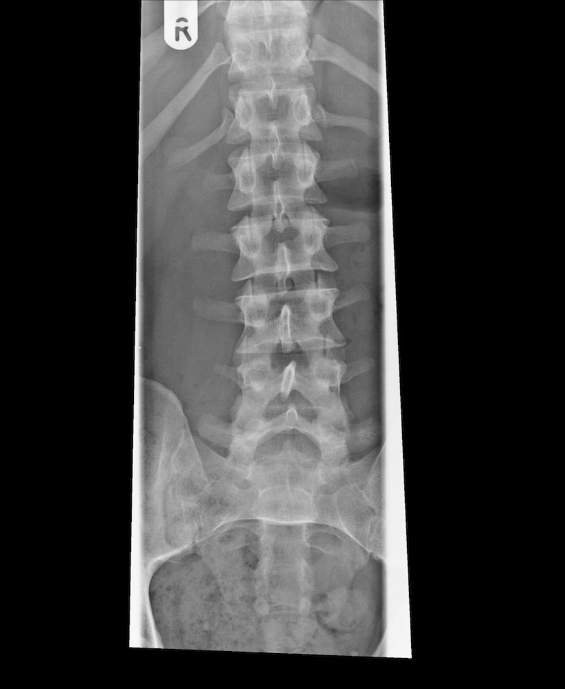 XRay of a Normal Lumbar Spine AP View