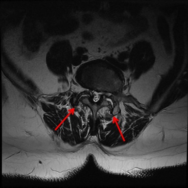 MRI Showing Facet Joint Degeneration