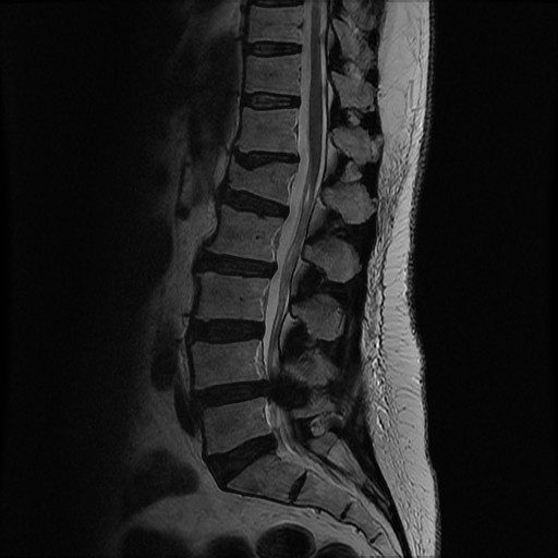 MRI Showing Spinal Stenosis at Single Level