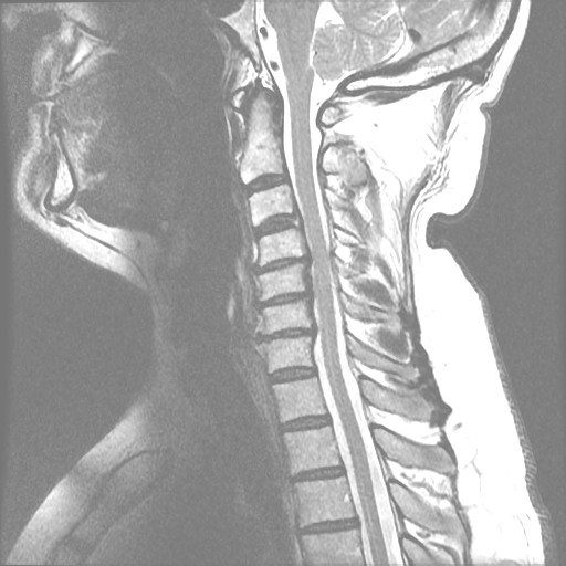 Midsagittal T2 Cervical Spine MRI Of The Previous X-Ray Showing Multi Level Degenerative Changes