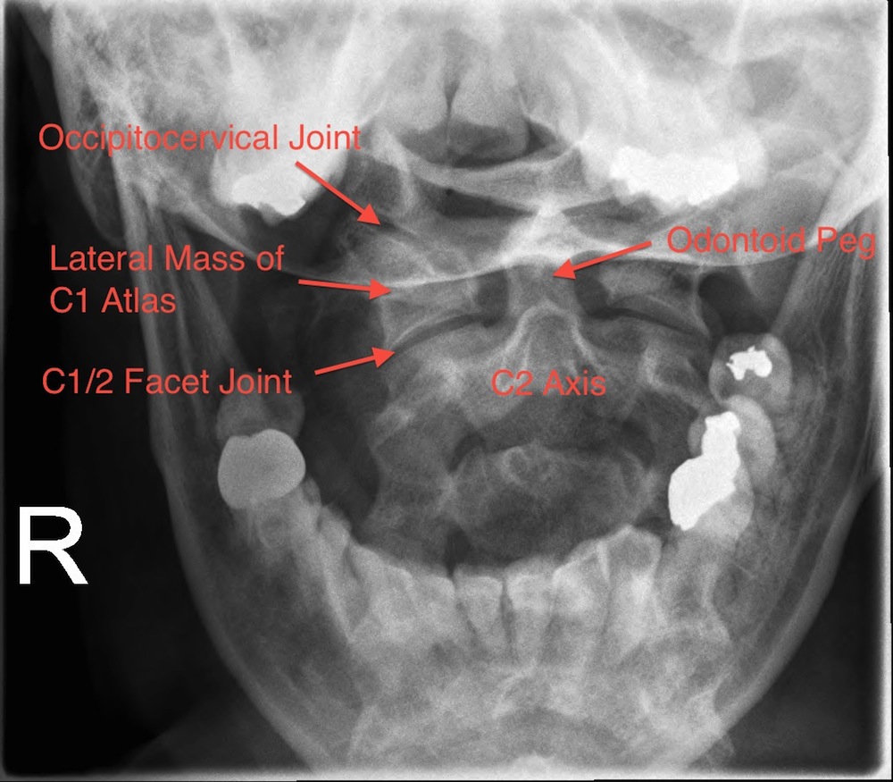 Normal Cervical Spine Peg View X-Ray