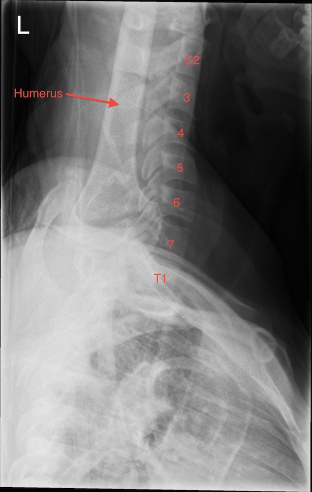 Normal Swimmers View Cervical Spine Lateral X-Ray