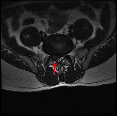 MRI Showing a Disc Prolapse 2