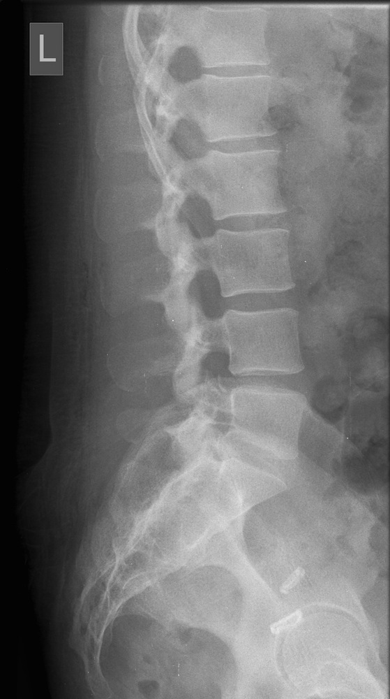 Postoperative Erect Lateral X-Ray