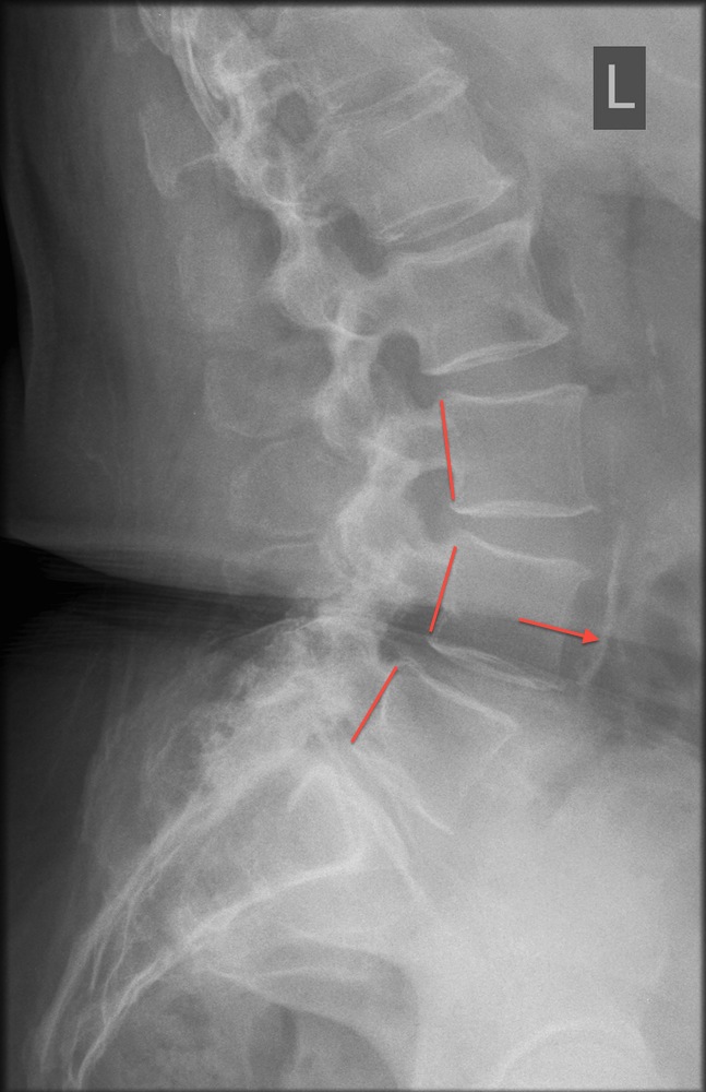Preoperative Erect Lateral X-Ray Showing Degenerative Spondylolisthesis of L4 on L5