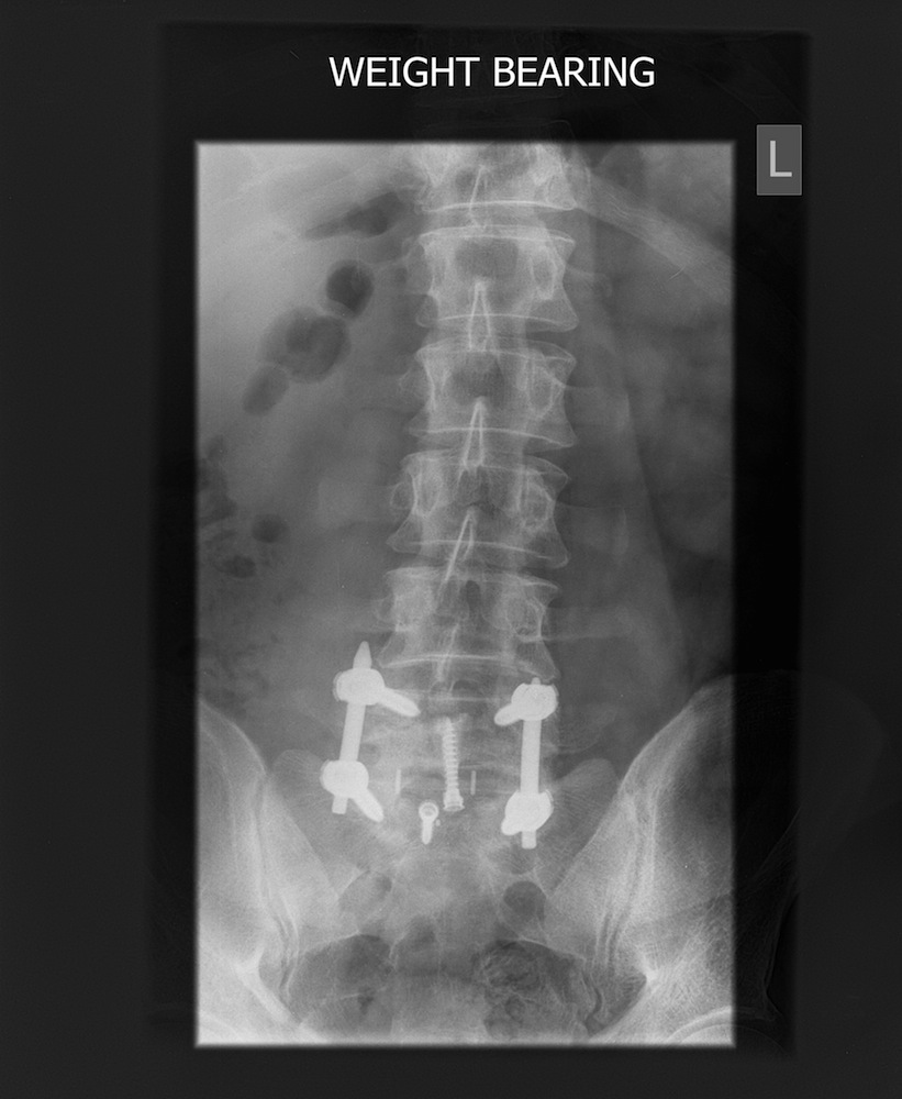 Postoperative Erect AP X-Ray Showing Anterior and Posterior Instrumented Fusion