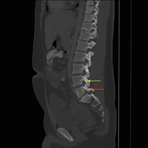 CT Showing Spondylolysis - the red arrow shows the defect, green arrow shows a normal pars
