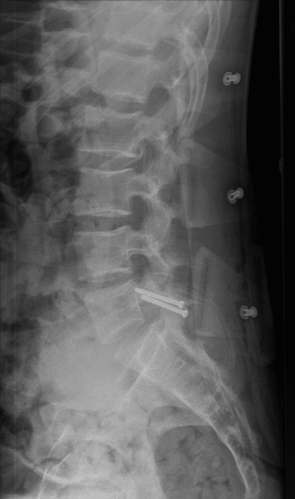 Erect Lateral X-Ray Showing Direct Pars Repair with Screws