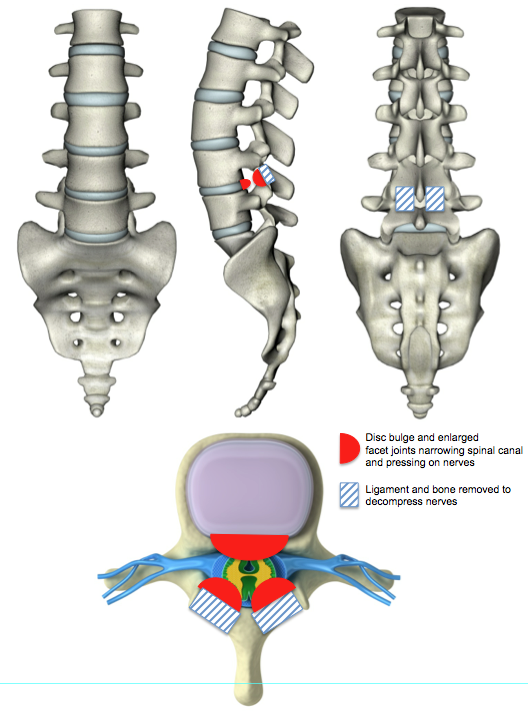 Illustration of Segmental Decompression for Stenosis