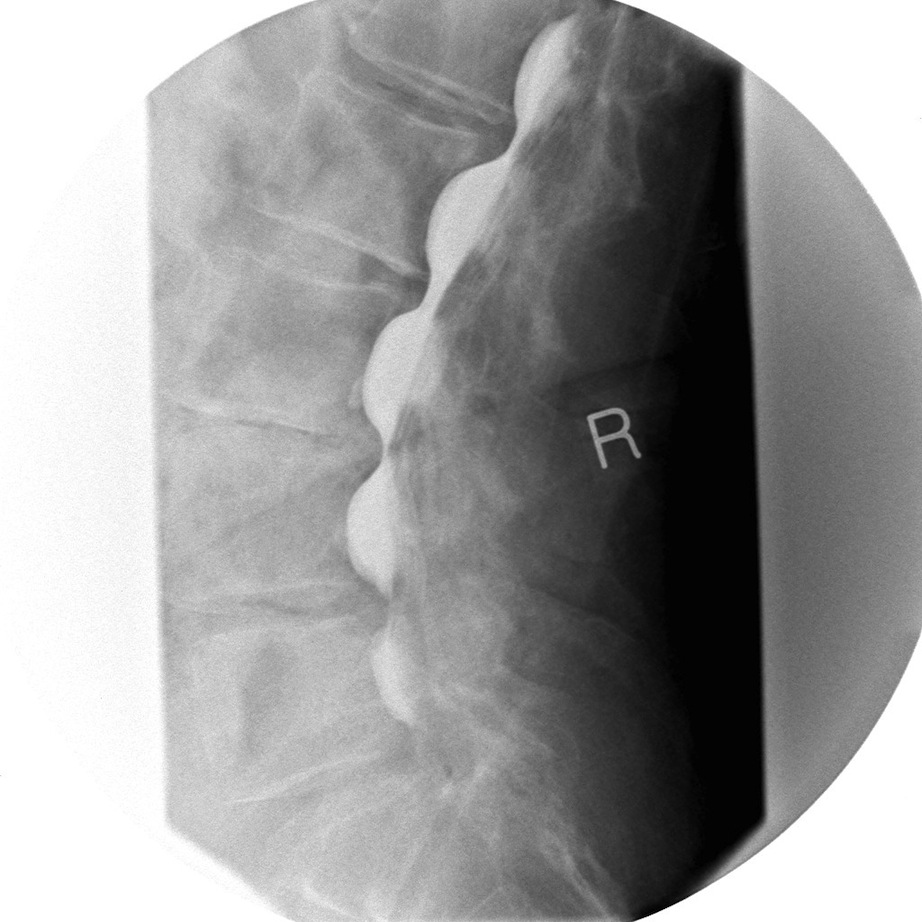 Myelogram Lateral