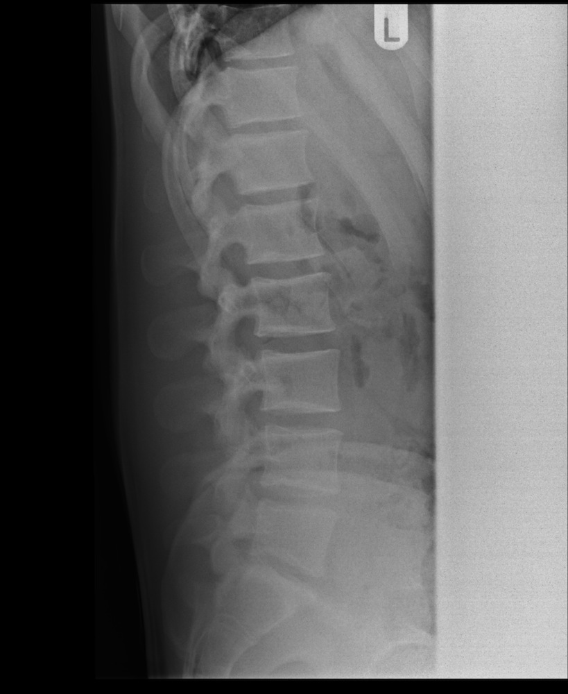 XRay of a Normal Lumbar Spine Lateral View