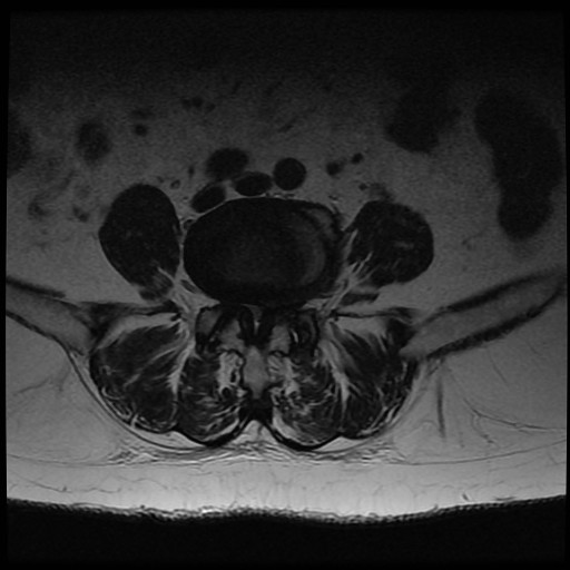 MRI Showing Spinal Stenosis