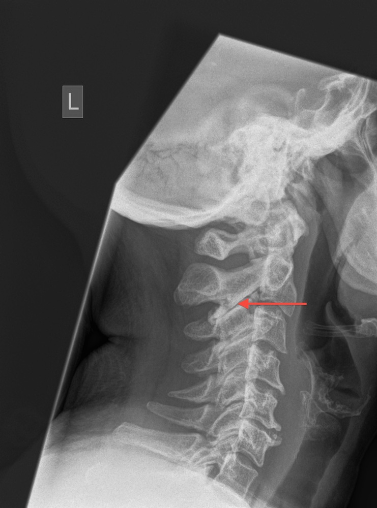 Lateral Cervical Spine X-Ray Showing An Arthritic Cervical Facet Joint