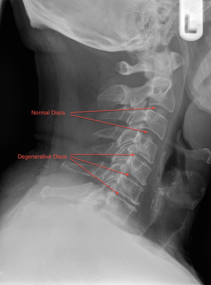 Lateral Cervical Spine X-Ray Showing Multi Level Degenerative Changes