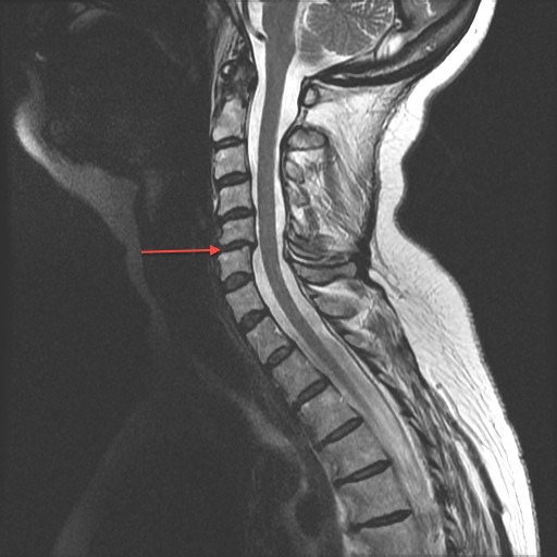 Midsagittal T2 Cervical Spine MRI Of The Previous X-Ray Showing The Degenerative C5:6 Disc