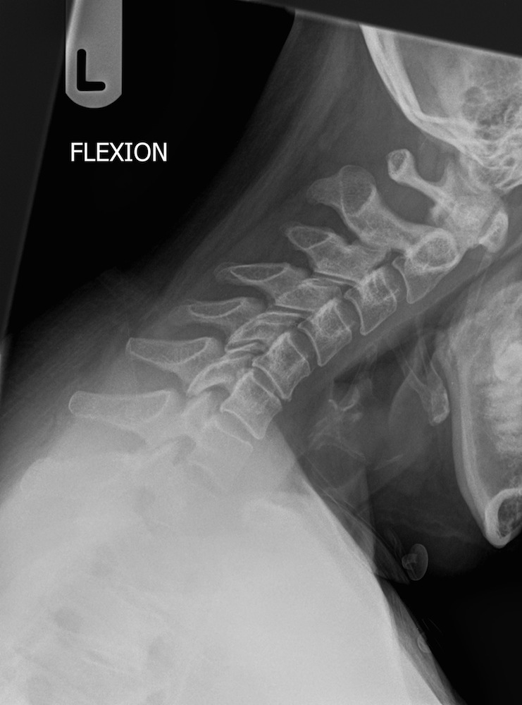 Normal Flexion Extension Lateral Cervical Spine X-Ray 1