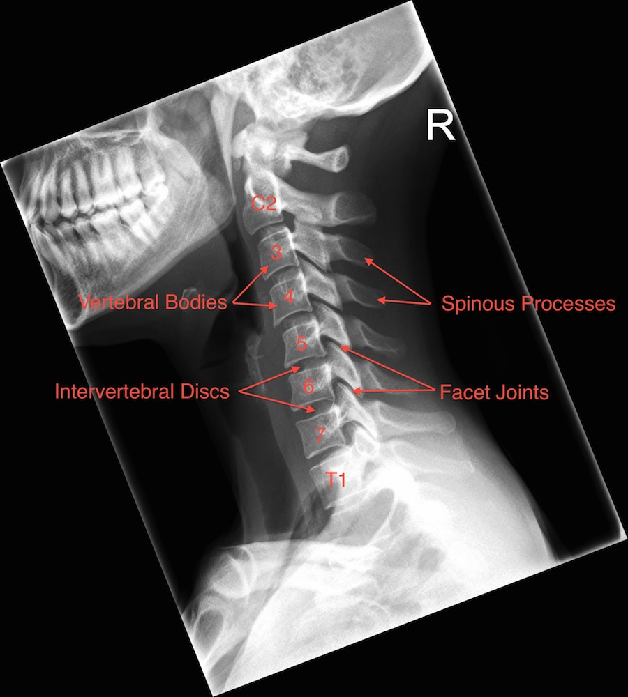 Normal Lateral Cervical Spine X-Ray