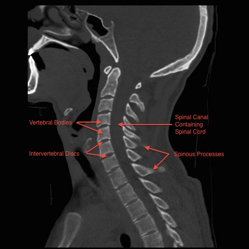 Normal Midsagittal Cervical Spine CT