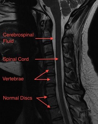 Normal Midsagittal T2 Cervical Spine MRI