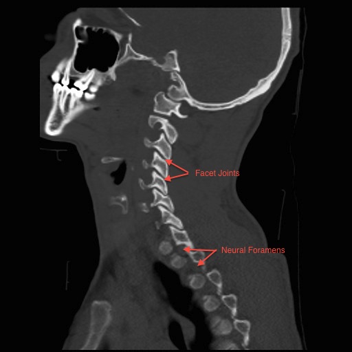 Normal Parasagittal Cervical CT Scan