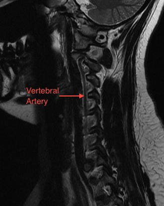 Normal Parasagittal T2 Cervical Spine MRI Showing the Vertebral Artery
