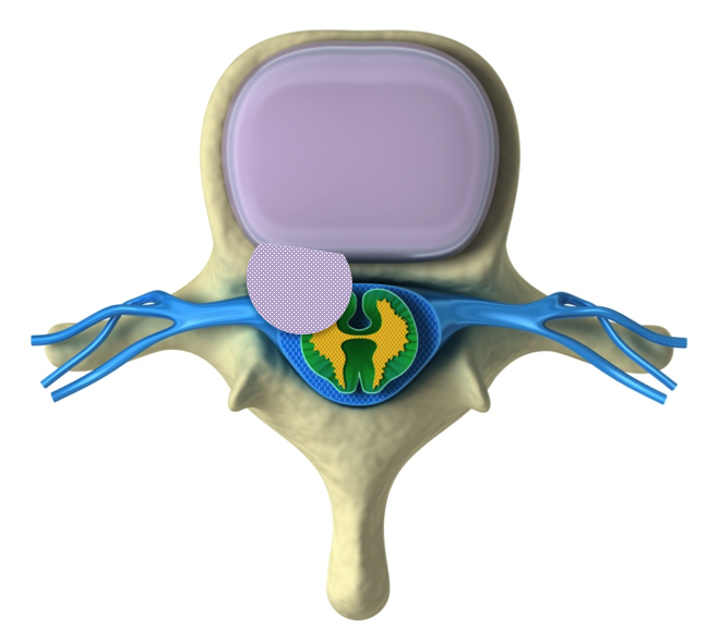 Illustration of the disc prolapse