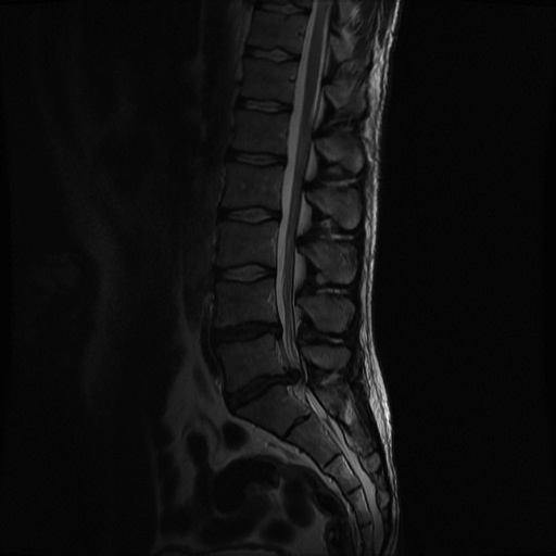 MRI showing disc filling spinal canal causing cauda equina syndrome 1