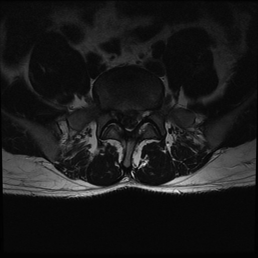 MRI showing disc filling spinal canal causing cauda equina syndrome 2