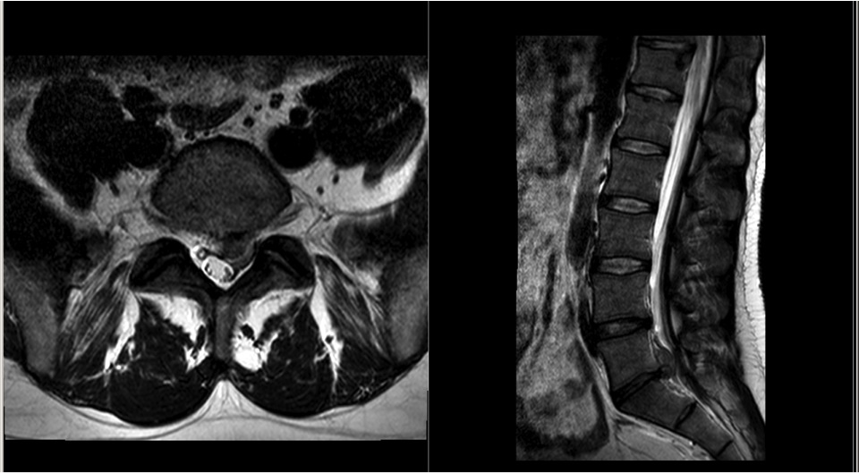 MRI showing initial disc prolapse