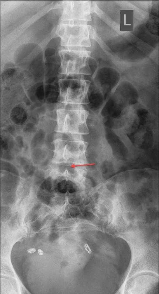 Postoperative Erect AP X-Ray Showing Bilateral Segmental Decompression