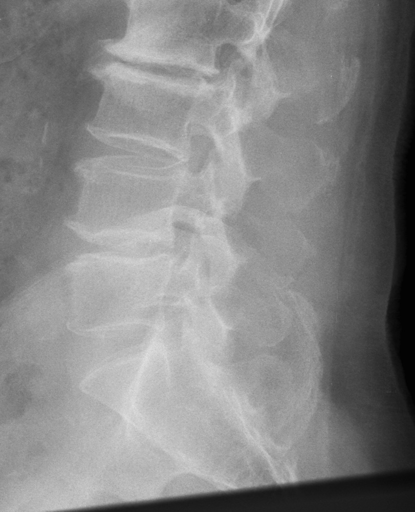 Preoperative Erect Lateral X-Ray
