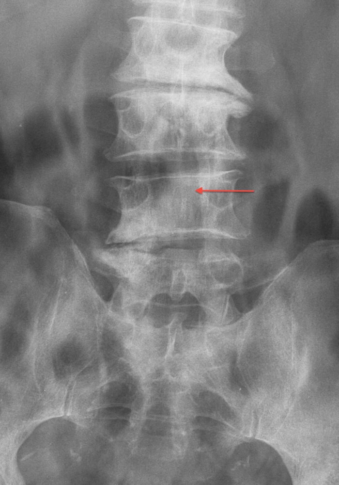 Postoperative Erect AP X-Ray - Laminectomy Decompression