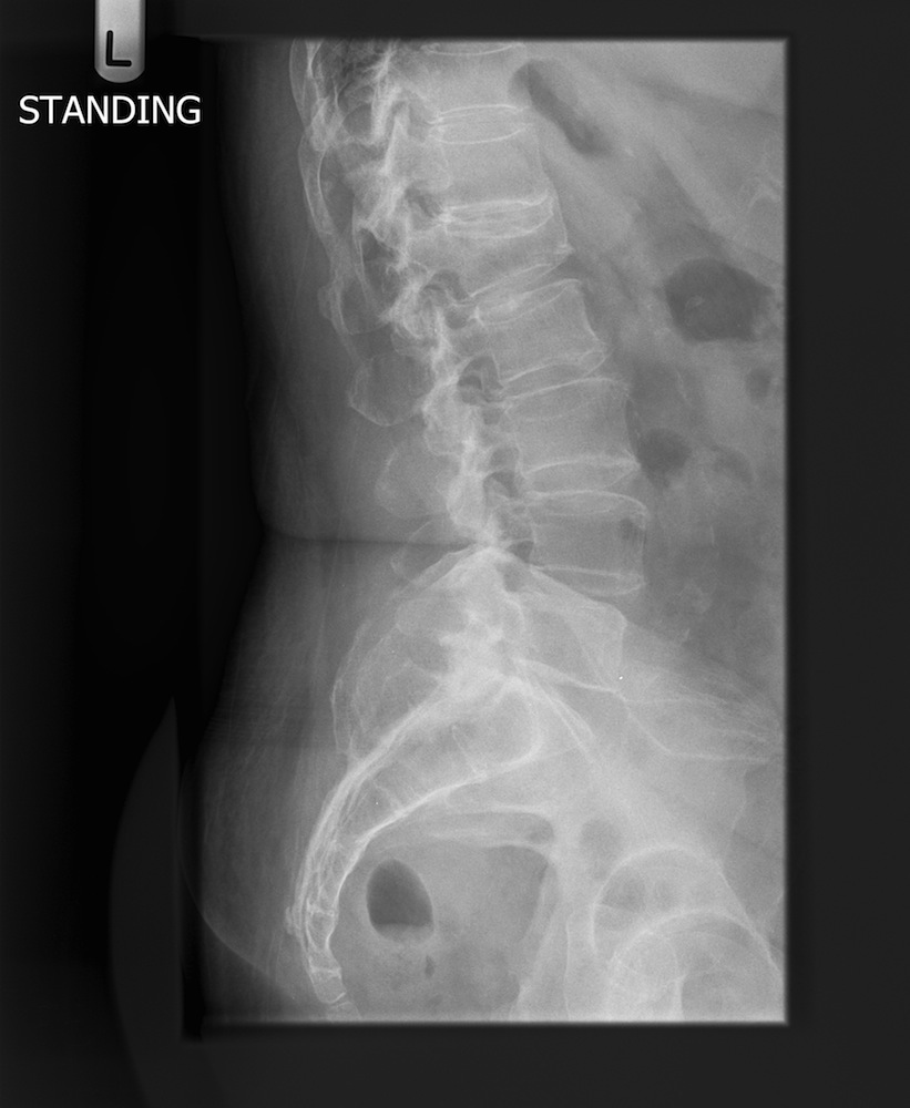 Postoperative Erect Lateral X-Ray Showing No Increase in the Spondylolisthesis