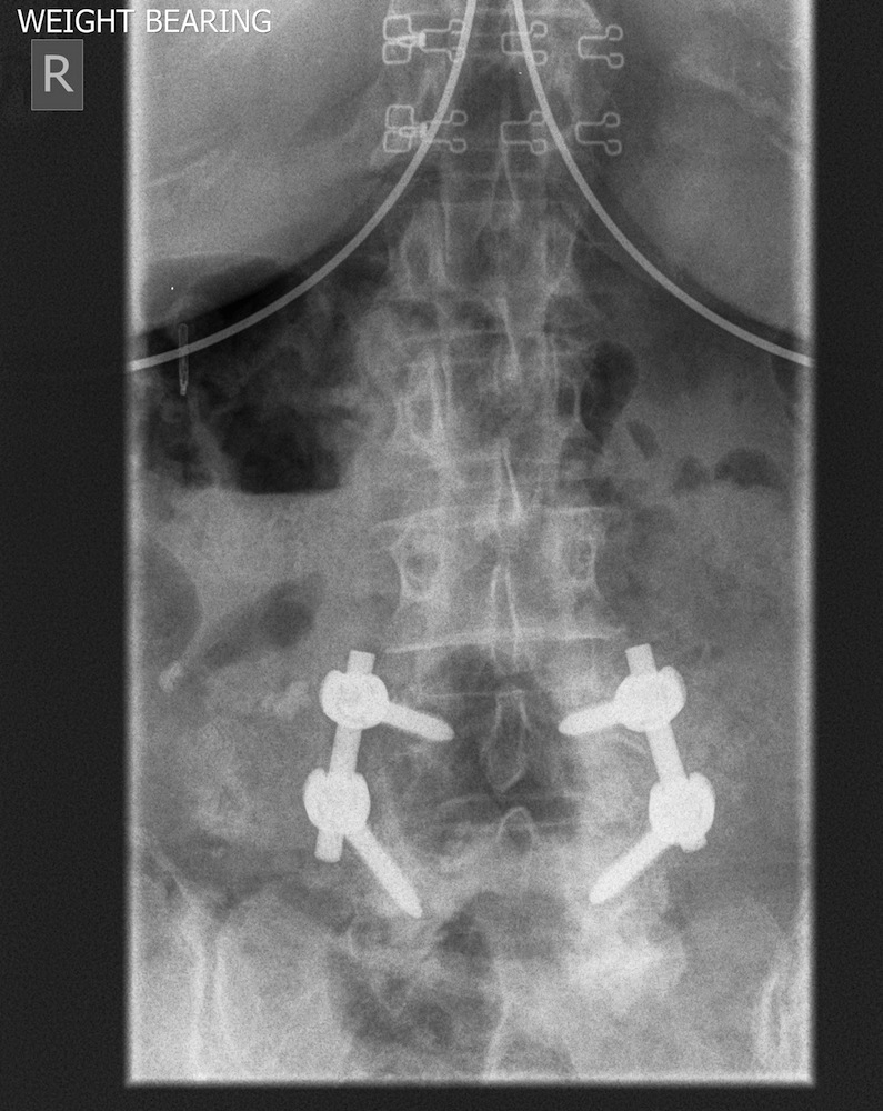 Postoperative Erect AP X-Ray Showing Decompression and Instrumented Fusion