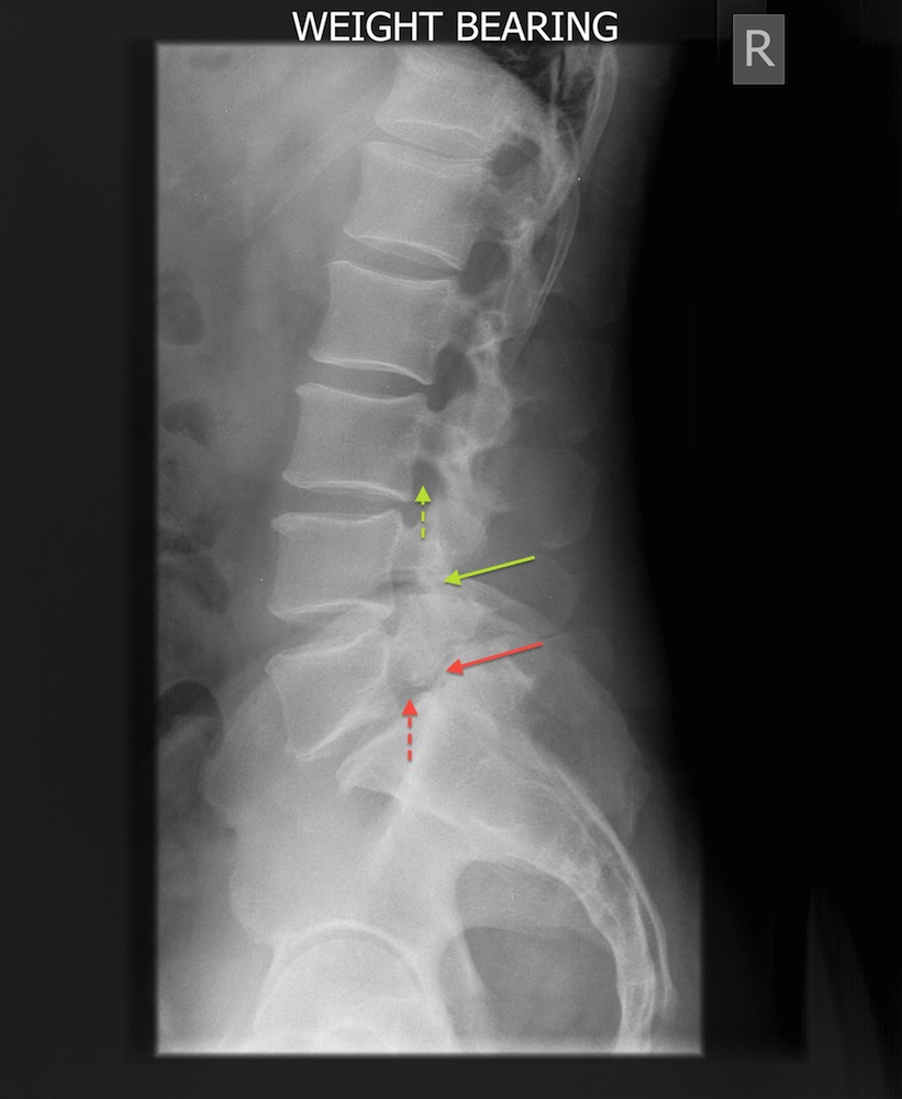 Preoperative Erect Lateral X-Ray of Lytic Spondylolisthesis - red arrow shows the lysis, green arrow shows a normal pars, dashed red arrow shows narrow neural foramen