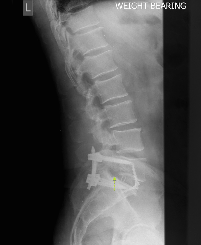 Postoperative Erect Lateral X-Ray Showing Anterior and Posterior Instrumented Fusion - a cage has been placed in the disc space to restore the foraminal height