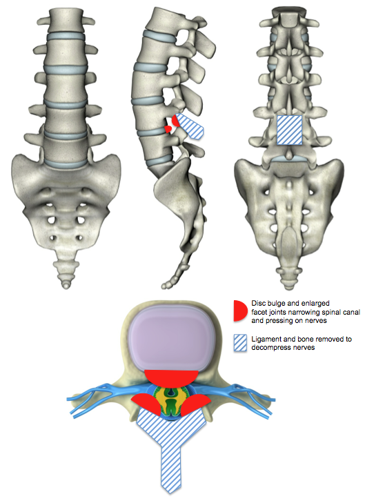 Illustration of Laminectomy Decompression for Stenosis