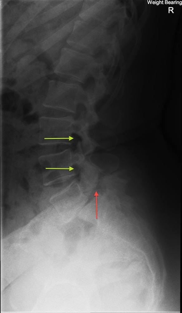 X-Ray Showing Lytic Spondylolisthesis - green arrows show normal neural foramens red arrow shows narrowed foramen
